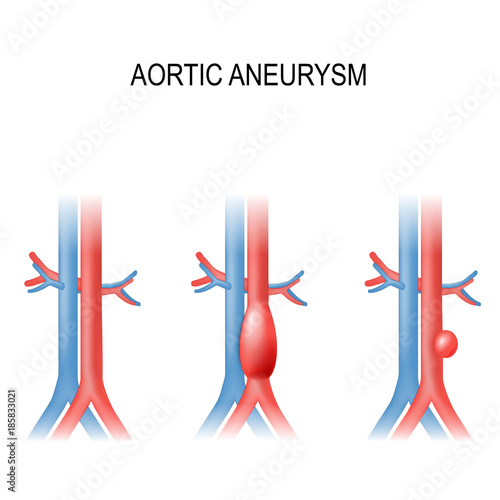 abdominal aortic aneurysm