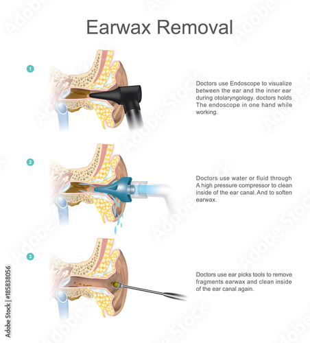 Earwax Removal. EARWAX s a common problem which is easily treated.