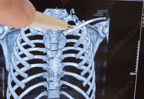 Принти на полотні Doctor points out pen on clavicle in picture of 3D computer tomography