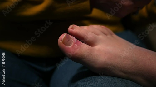 Close up of a red inflamed infected toe
