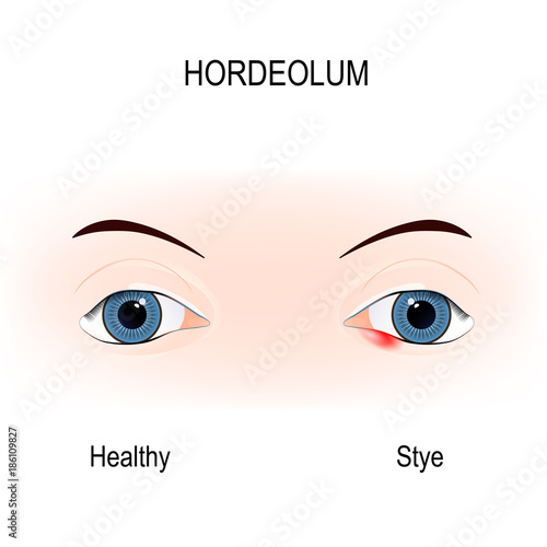 Eyes of human. stye. external hordeolum of lower eyelid.