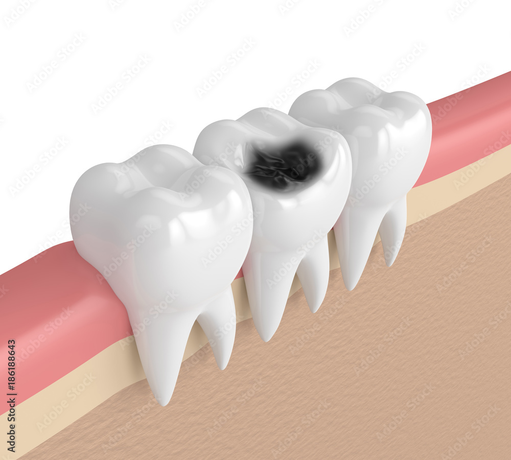 Εκτύπωση καμβά 3d render of teeth  in gums with decay