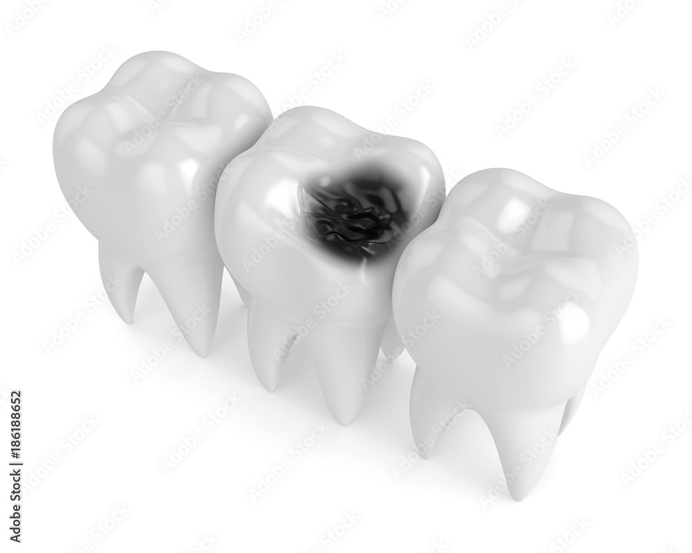 3d render of teeth with decay