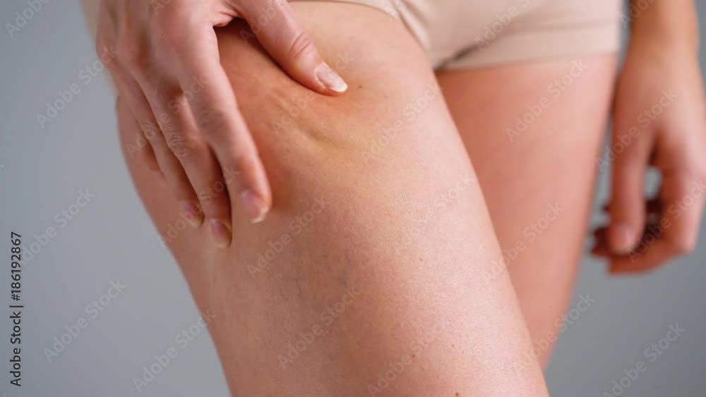 Female hip stretch marks and cellulite on the skin Female hip stretch marks and cellulite on the skin