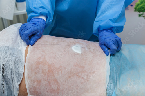 A woman undergoes the Carboxytherapy procedure on her stomach in a beauty salon. The doctor applies special paper sheets The procedure is based on oxygen CO2 photo