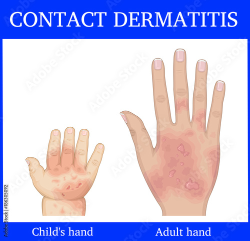 Illustration of Contact Dermatitis photo