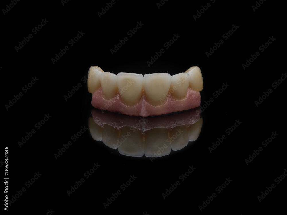 Metal Ceramic Bridge