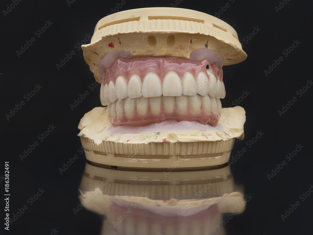 Complete lower and upper metal ceramic prosthesis dental screwed directly to implant. Complete lower and upper metal ceramic prosthesis dental screwed directly to implant.