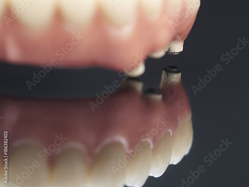 Mechanized connections. Complete lower prosthesis dental screwed