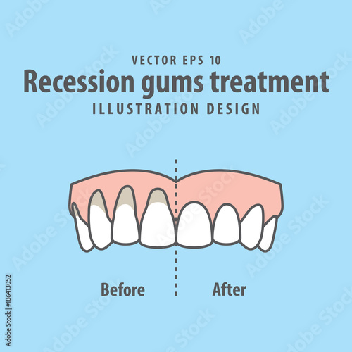 Compare upper teeth Recession gums treatment before and after illustration vector on blue background. Dental concept.