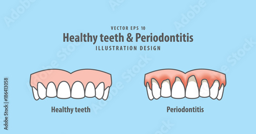 upper healthy teeth & Periodontitis illustration vector on blue background. Dental concept.