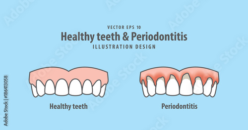 upper healthy teeth & Periodontitis illustration vector on blue background. Dental concept. photo