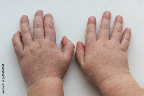 Scarlet fever. Two children's hands with rash on white background.