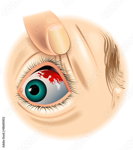 symptoms of subconjunctival hemorrhage