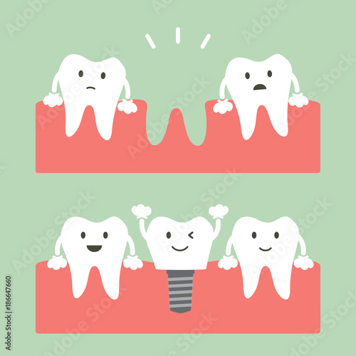 filling dental implant with crown, before and after