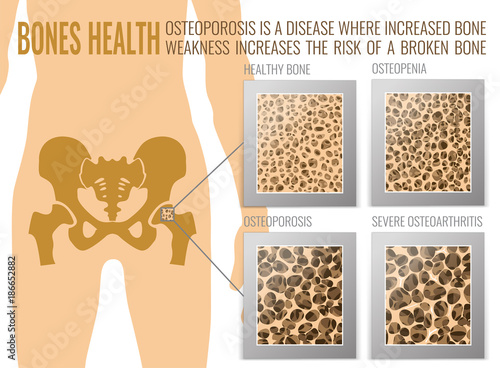 Osteoporosis Bones Poster