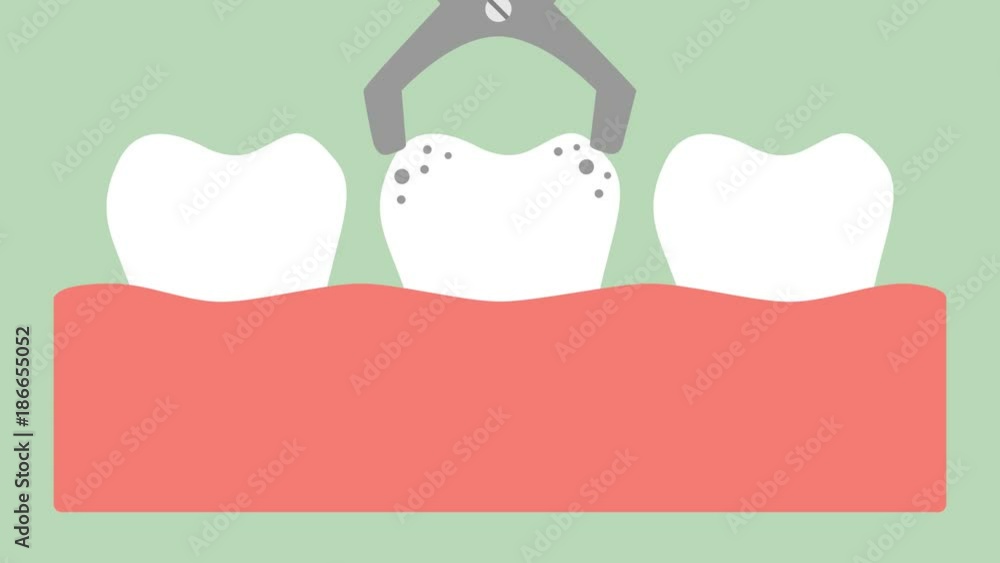 Debris Tooth Animation tooth extraction by dental tools, removal decay tooth - dental cartoon ...