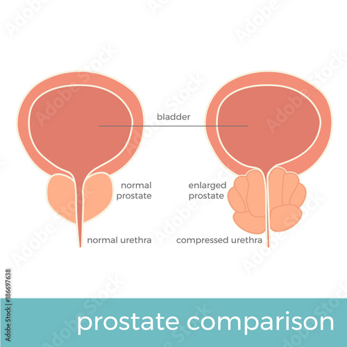 vector illustration of normal and enlarged prostate comparison photo