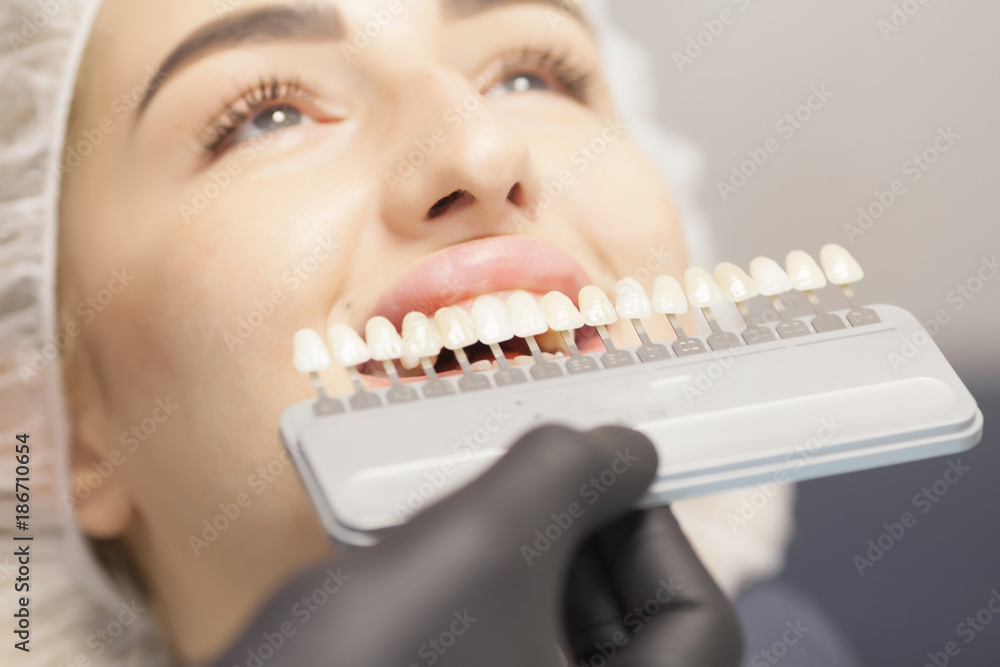 Beautiful european woman smile with healthy teeth whitening. Dental care concept. Set of implants with various shades of tone Beautiful european woman smile with healthy teeth whitening. Dental care concept. Set of implants with various shades of tone