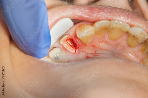 tooth close-up with a dental mirror