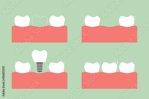 step of caries to dental implant with crown, before and after