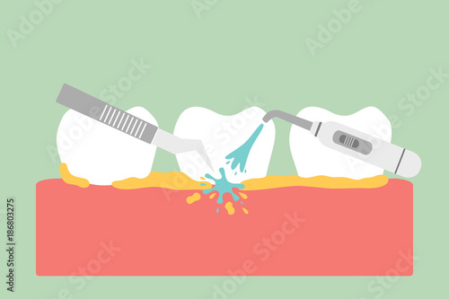 teeth scaling, dental plaque removal for cleaning