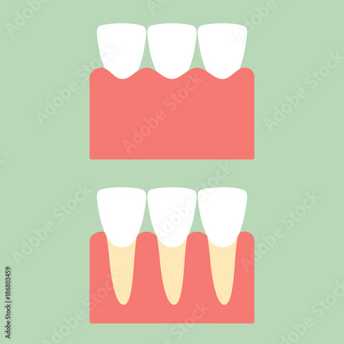 healthy incisor tooth on gum for dental care