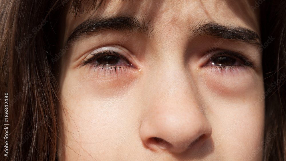 yeux larmoyants yeux larmoyants