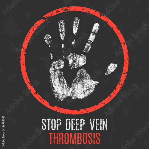 The medical diagnosis. Stop deep vein thrombosis.