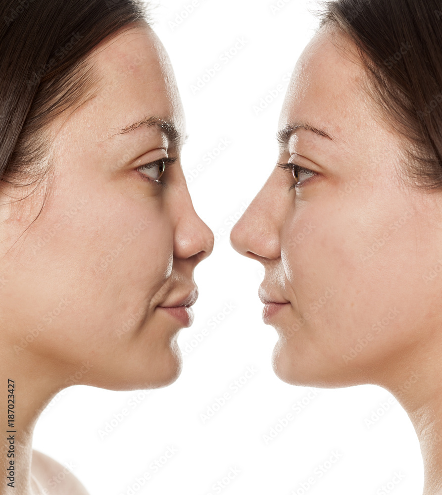 woman's profile, before and after nose surgery woman's profile, before and after nose surgery