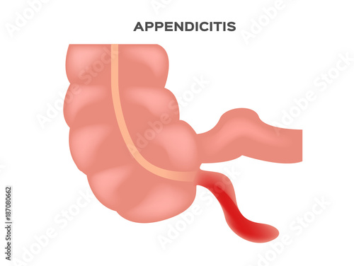 appendicitis vector in white background
