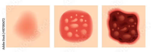 step of burn . Normal to serious burn skin . vector and icon