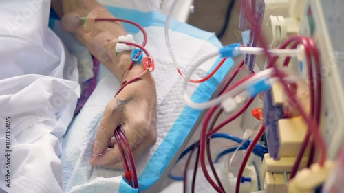An arm with raised veins connected to a kidney machine.  photo