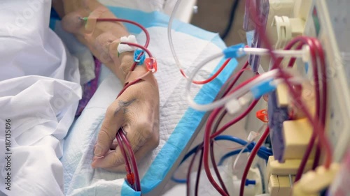 An arm with raised veins connected to a kidney machine. 