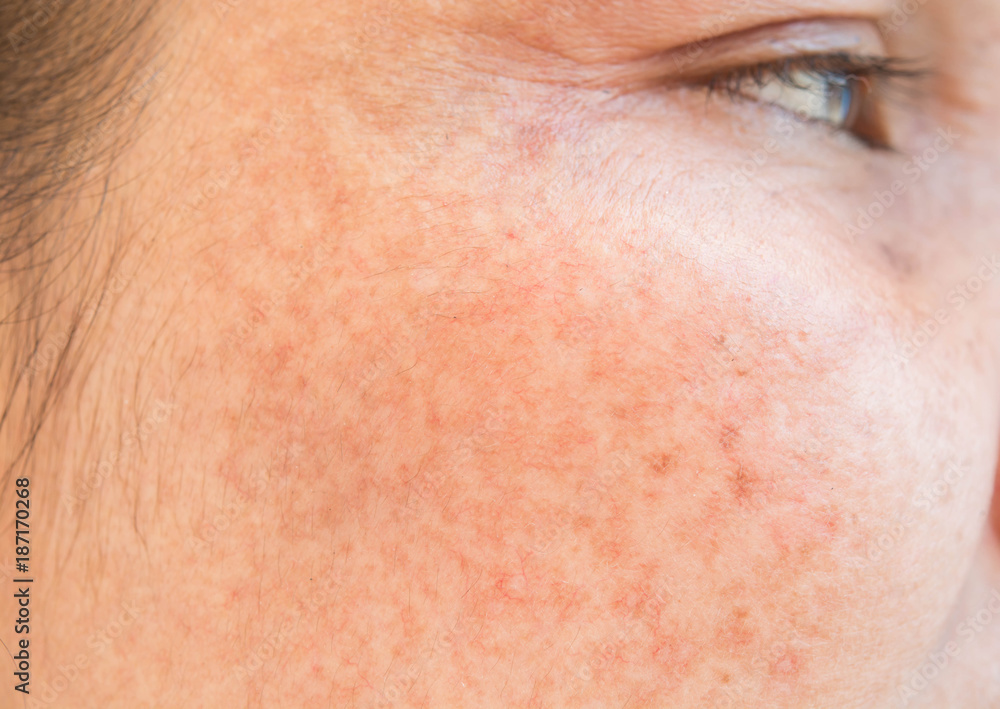 freckles on the face freckles on the face