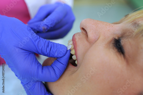 Dentist puts dental veneers patient and correction of teeth photo
