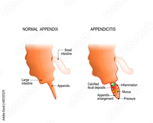 Healthy and Inflamed appendix.