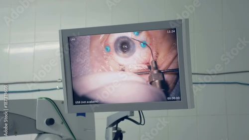 A feed of an eye surgery shown on a large screen.  photo