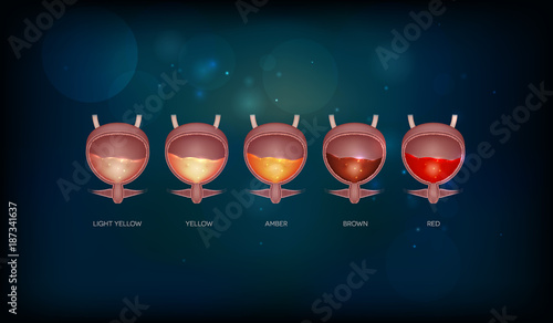 Urinary bladder and various urine colors from light yellow till red color. Urinary bladder detailed anatomy and urine inside on a dark background