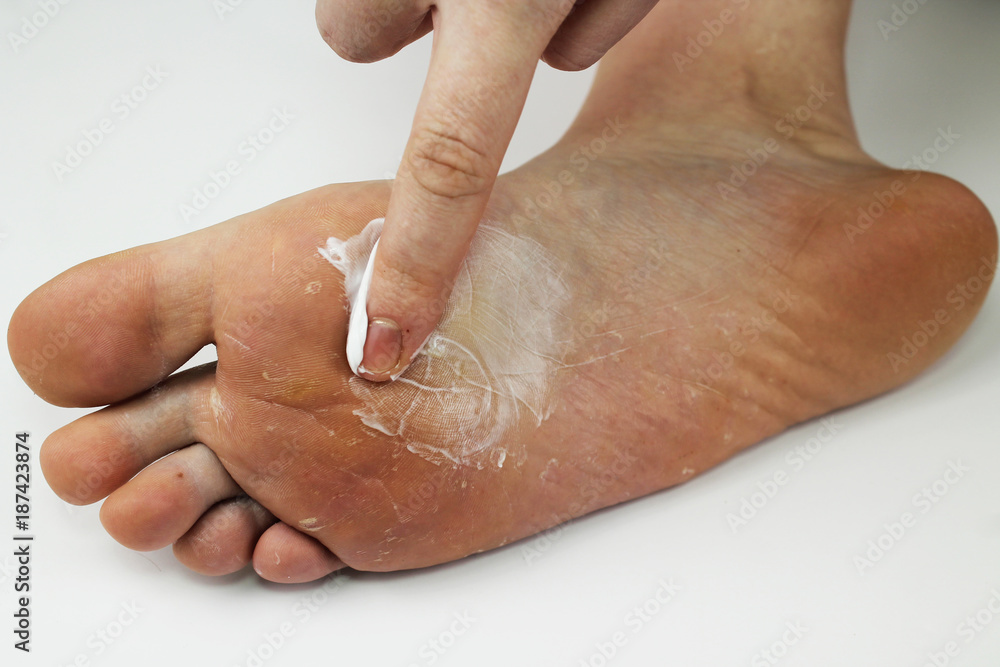Fototapeta premium Fungus of foot close-up, isolated on white background. The concept dermatology, treatment fungal and fungal infections in humans. Macro video human feet. To smear a leg with antifungal ointment
