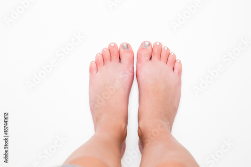 Woman's legs red toes hurt after freezing outside in winter. Cold barefoot.