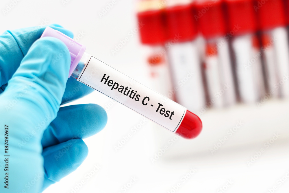 Obraz premium Test tube with blood sample for hepatitis C virus (HCV) test