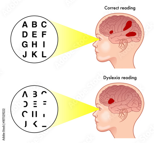 Schilderij op canvas medical illustration of the symptoms of dyslexia