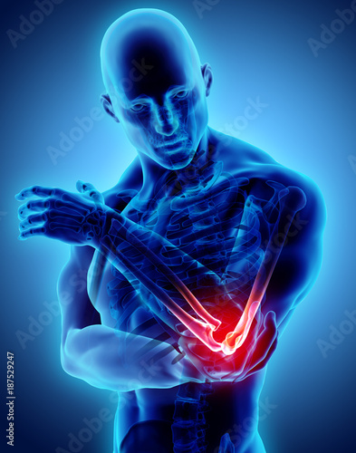 Canvas Print 3d illustration of human elbow injury.