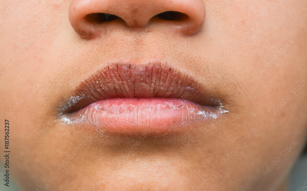 Dry lips and peeling Dry lips and peeling