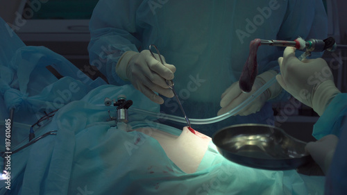 Operation using laparoscopic equipment. Surgeons team. Hospital.
