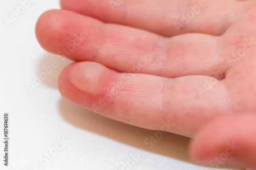 Slika na platnu blister on a child's finger