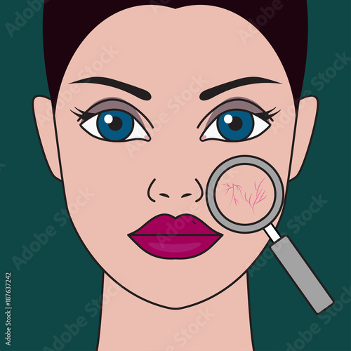 Rosacea on face of girl