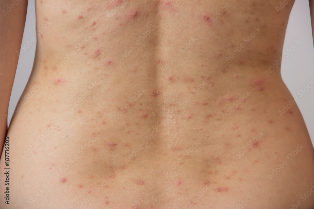 Young girl with acne, with red spots on the back Young girl with acne, with red spots on the back