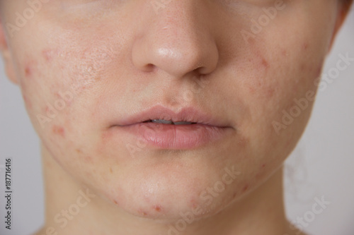 Beautiful young girl with red acne on her face on a white background